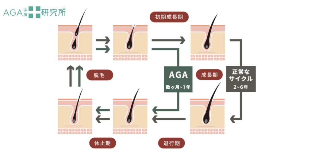 AGA（男性型脱毛症）のヘアサイクルと正常なヘアサイクル