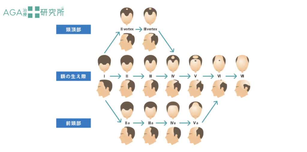 AGA（男性型脱毛症）の進行度やタイプをハミルトン・ノーウッド分類で解説