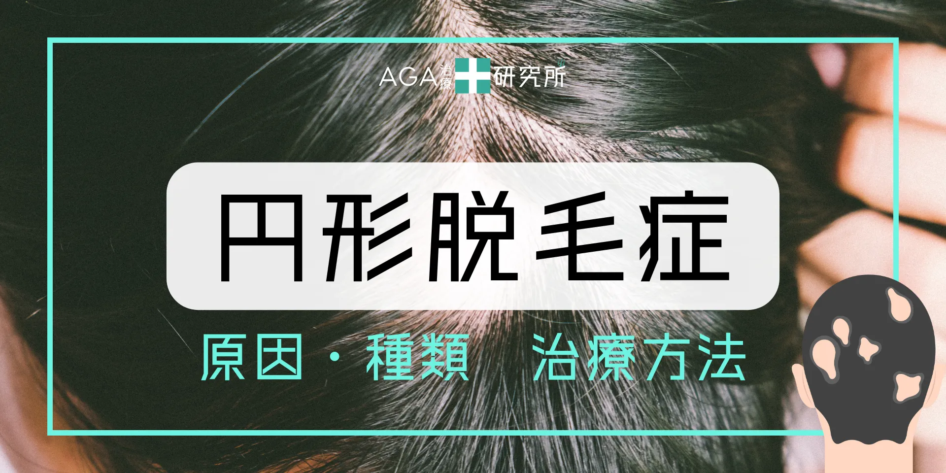 円形脱毛症の原因・種類・治療方法を徹底解説！不安を解消する対策