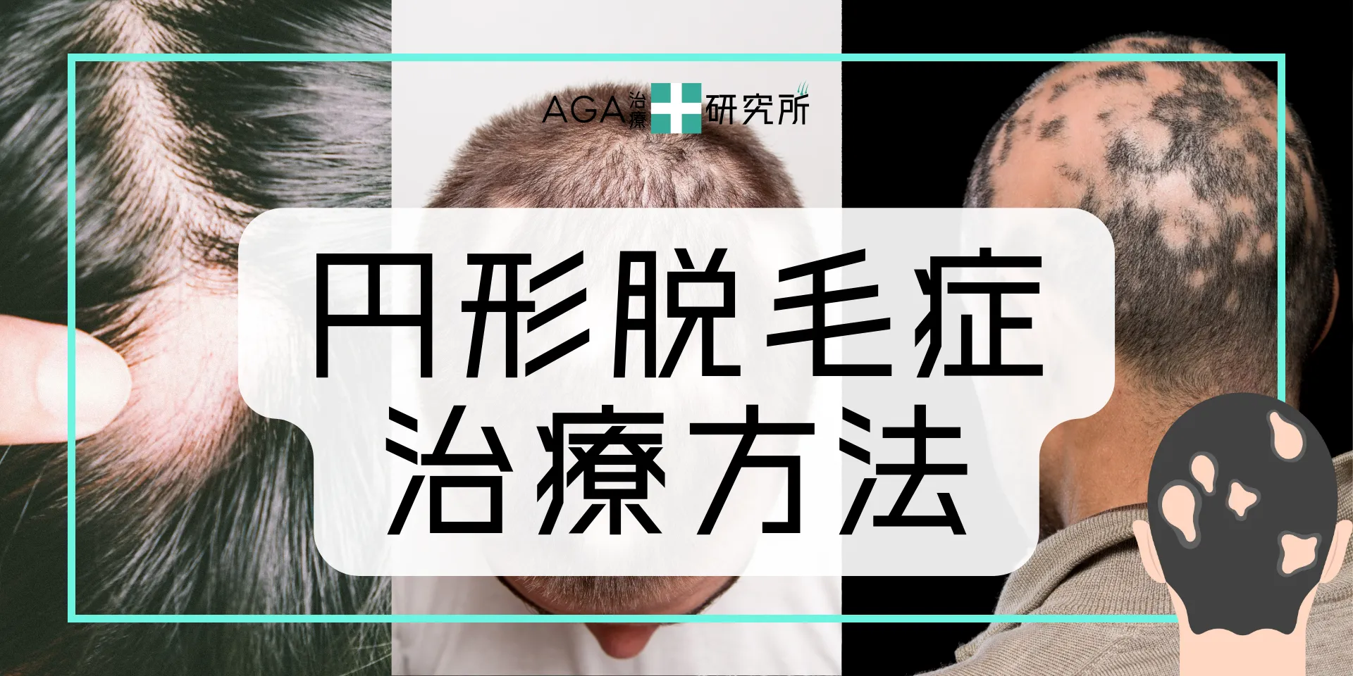 円形脱毛症の治療方法