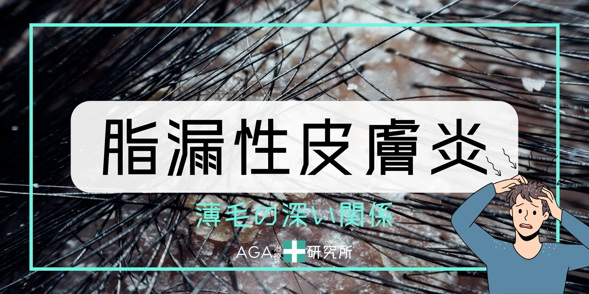 脂漏性皮膚炎と薄毛の深い関係とは？原因・症状・治療法を徹底解説